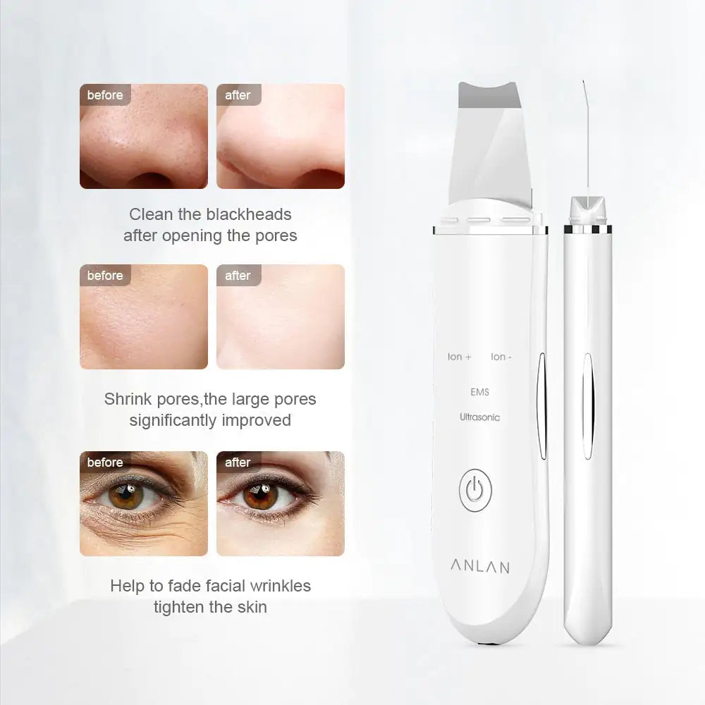 Ultrasonic Skin Scrubber Pro